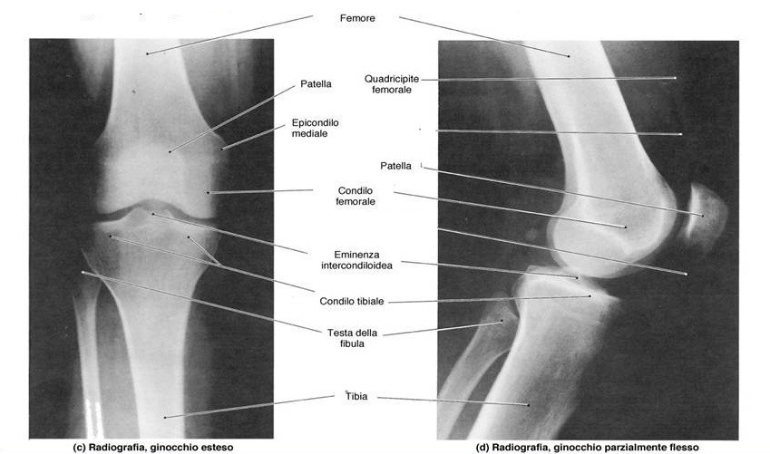 ARTICOLAZIONE DEL GINOCCHIO Il ginocchio è un ginglimo angolare le cui superfici articolari sono costituite dai condili femorali e da quelli tibiali.