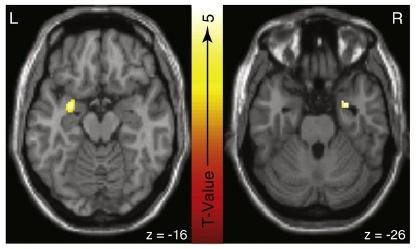 NEUROIMMAGINI E AGGRESSIVITA Soggetti con alta disposizione ad esprimere rapidamente aggressività e rabbia hanno una risposta amplificata dell amigdala di sinistra a facce terrorizzanti Alti livelli