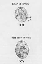 Corpi di Barr Cromosoma X inattivato nelle femmine Nella maggior parte dei nuclei, sembra