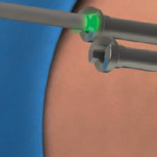 18 Il chirurgo, in genere, crea un portale AM distale per centrare l impronta anatomica del LCA, creando un tunnel laterale molto basso.