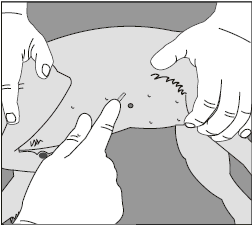 Fig.1 Fig.2 Fig.3 Fig.4 RIMOZIONE: Per rimuovere l impianto può rendersi necessaria una contenzione chimica (sedazione e/o anestesia generale).