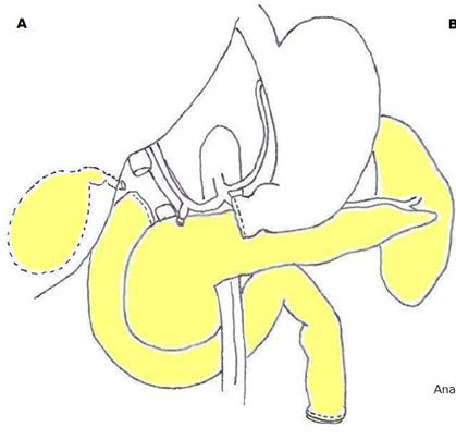 Splenopancreasectomia totale Esame istologico: Adenocarcinoma dei dotti del pancreas esocrino, ben differenziato (G1), infiltrante la parete muscolare del duodeno, senza affiorare sulla superficie