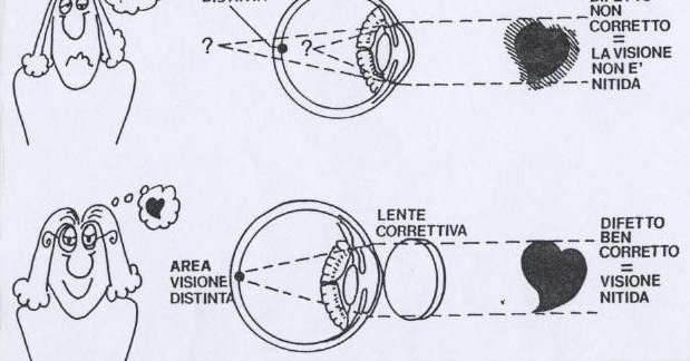 Difetti visivi mal corretti I principali difetti visivi non sono causati dall uso dei videoterminali ma possono, in talune condizioni, contribuire a far