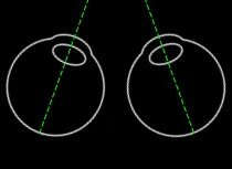 Convergenza Movimento riflesso di adduzione (rotazione verso l interno) simultaneo e sincrono dei globi oculari che fa convergere i due assi visivi sull