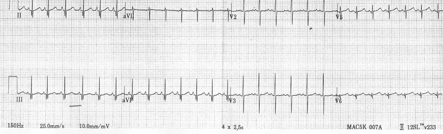 Asse QRS diretto nel quadrante inf.