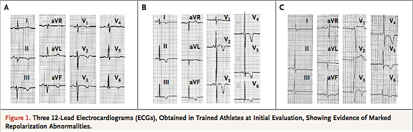 N Engl J Med. 2008 Jan 10;358(2):152-61 81 atleti giovani (23±6 a)allenati su 12550 senza sintomi o segni di cardiopatia.