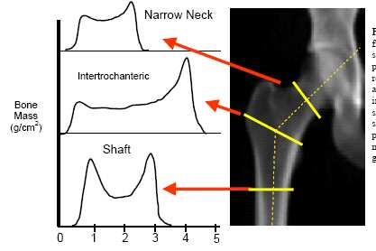 Resistenza ossea : HSA ( analisi strutturale del femore) variazioni dei parametri geometrici dell estremo prossimale del femore in relazione all invecchiamento e all