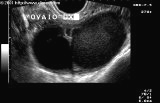 F. ECOGRAFIA L USO DELLA ECO TV E DI GRANDE AUSILIO NELLA DIAGNOSI DELLAE LESIONI OVARICHE (PER LE PIU PICCOLE) I LIMITI DELLA METODICA SONO LE LESIONI MINIME PERITONEALI I PICCOLI