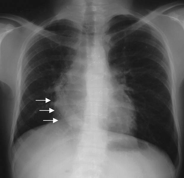 Capitolo 8 Difetti del setto interatriale e anomalie dei ritorni venosi polmonari 85 Esame fisico L apice cardiaco può essere spostato a destra (secondariamente a un ipoplasia del polmone destro).