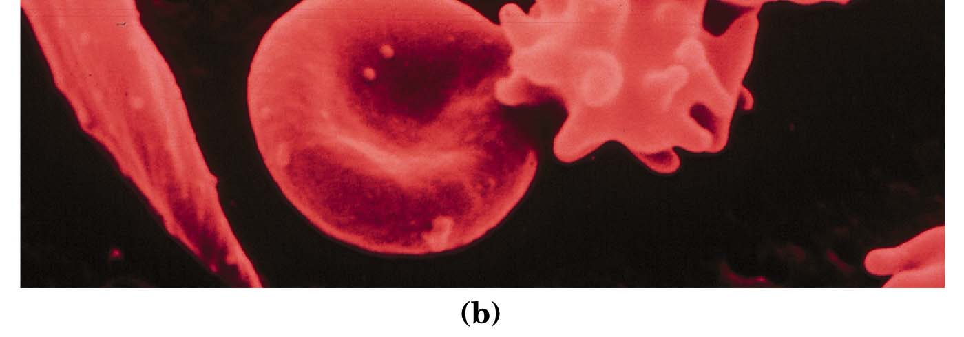 L anemia a cellule