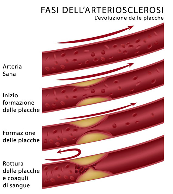 Esempio Il sangue scorre in un arteria di 0.