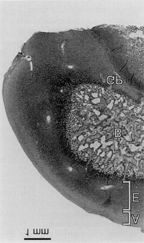 Osteocondrosi dissecante Localizzazione articolare caratterizzata dalla formazione di fessurazioni della superficie articolare con possibile distacco di frammenti osteocondrali È la