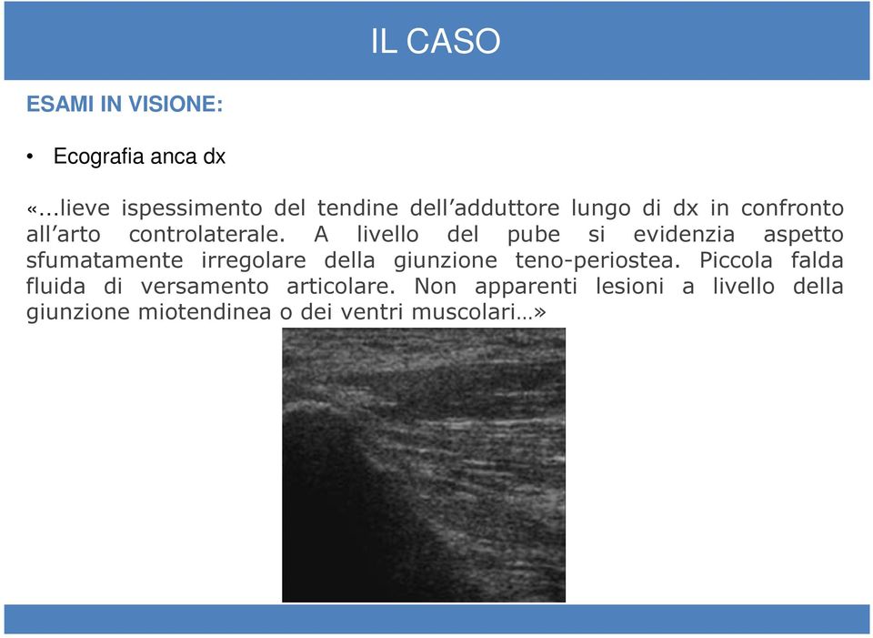 A livello del pube si evidenzia aspetto sfumatamente irregolare della giunzione