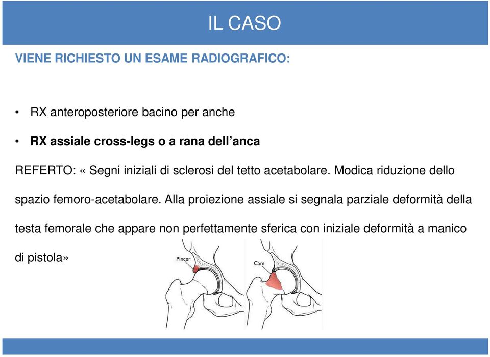 Modica riduzione dello spazio femoro-acetabolare.