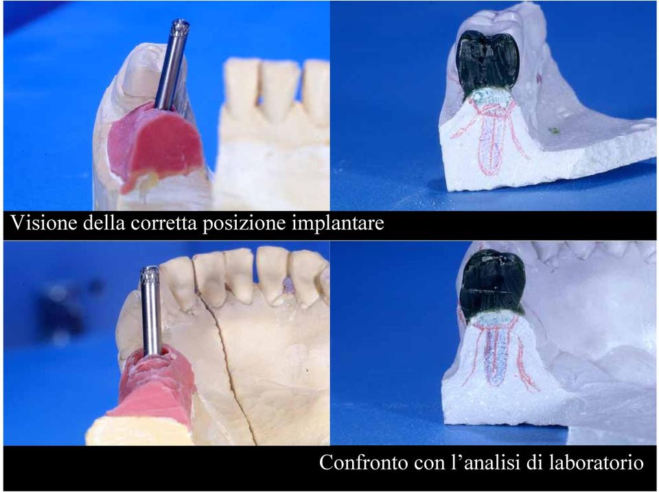 implantare Confronto