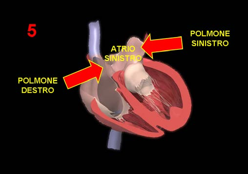 Durante il periodo dispnoico dell annegamento (dispnea inspiratoria), viene inalata una quantità variabile di liquido che dalle alte vie respiratorie raggiunge: alveoli capillari venule polmonari