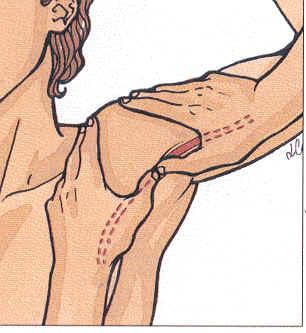 Compressione dell'arteria ascellare In caso di ferite al braccio o all'avambraccio.
