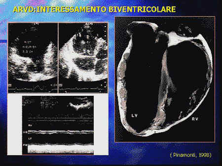 Ecocardiogramma ü Ventricolo destro ipocinetico, con parete assottigliata ed iperecogena, dilatato ü