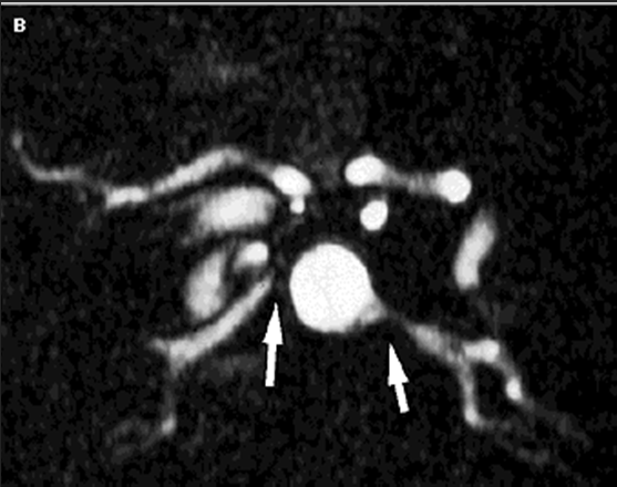 Angiografia: Fibrodisplasia arteria renale destra Angiografia: Stenosi bilaterale arterie