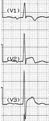 La sindrome di Brugada: un complesso problema cardiologico nell esperienza dell internista 37 Figura 4 Mutevolezza ingannevole del fenotipo nel tempo: da un ECG ben classificabile a un ECG pressoché