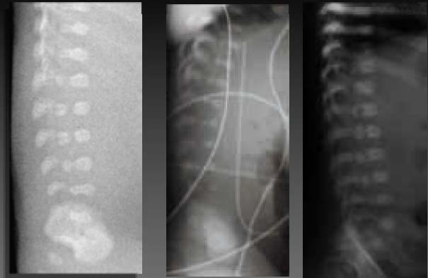 - linguiformi (Kniest) - a pera (fibrocondrogenesi) - con depressione