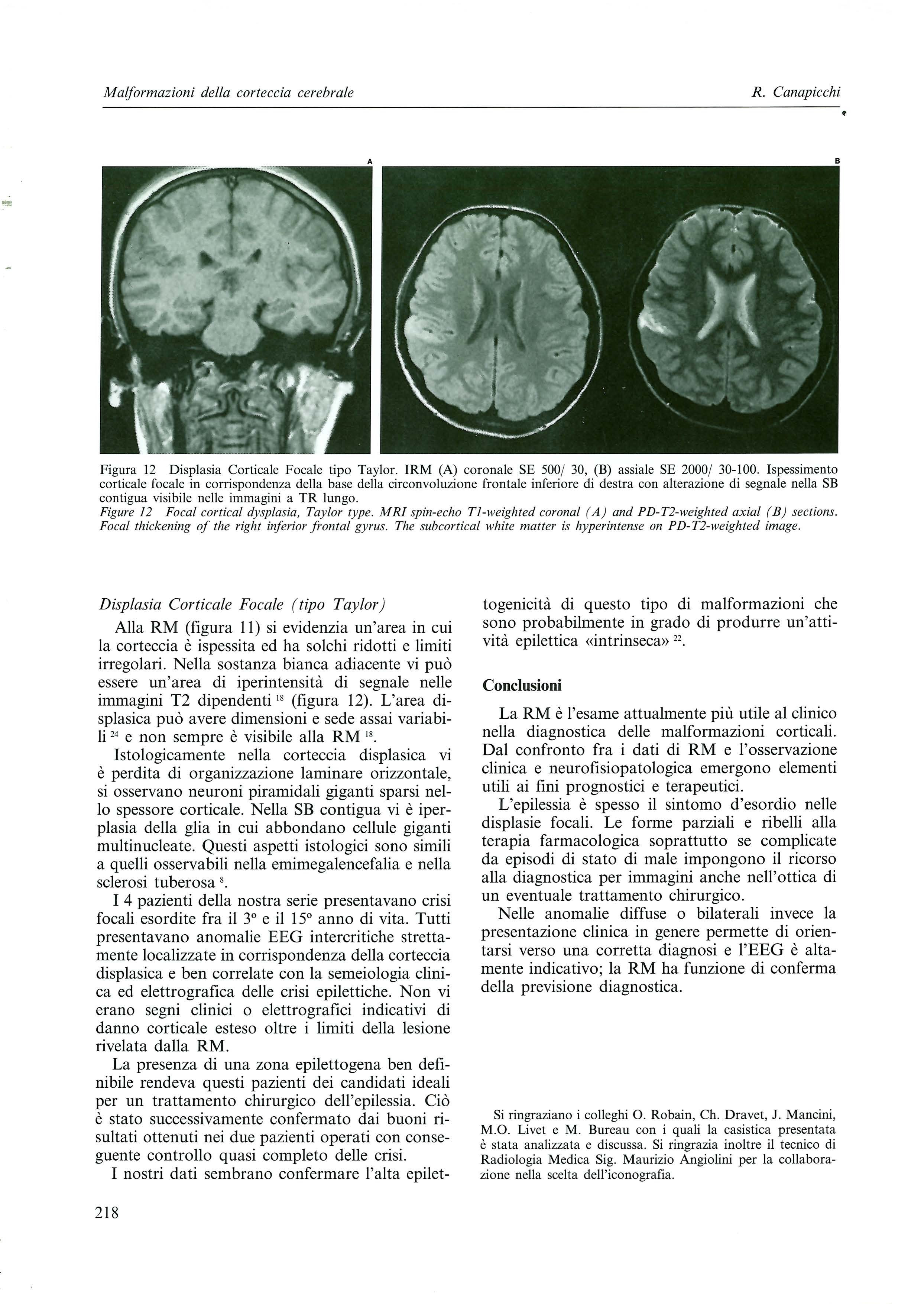 M alformazioni de!la corteccia cerebrate R. Canapicchi Figura 12 Dis~lasia Corticale Focale tipo Taylor. IRM (A) coronale SE 500/ 30, (B) assiale SE 2000/ 30-100.