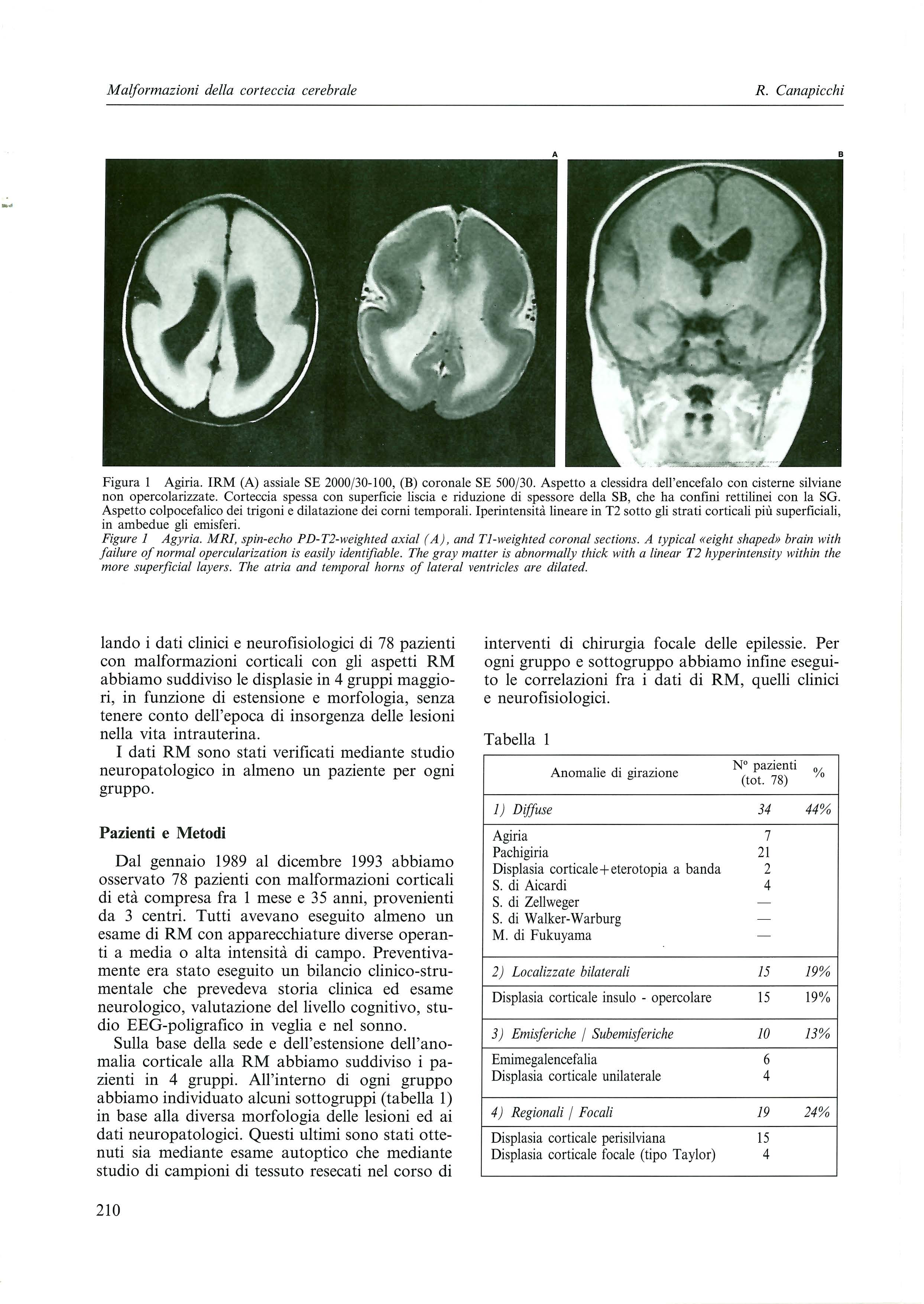 M alformazioni dell a cor teccia cerebrale R. Canapicchi Figura 1 Agiria. IRM (A) assiale SE 2000(30-100, (B) coronale SE 500/30.
