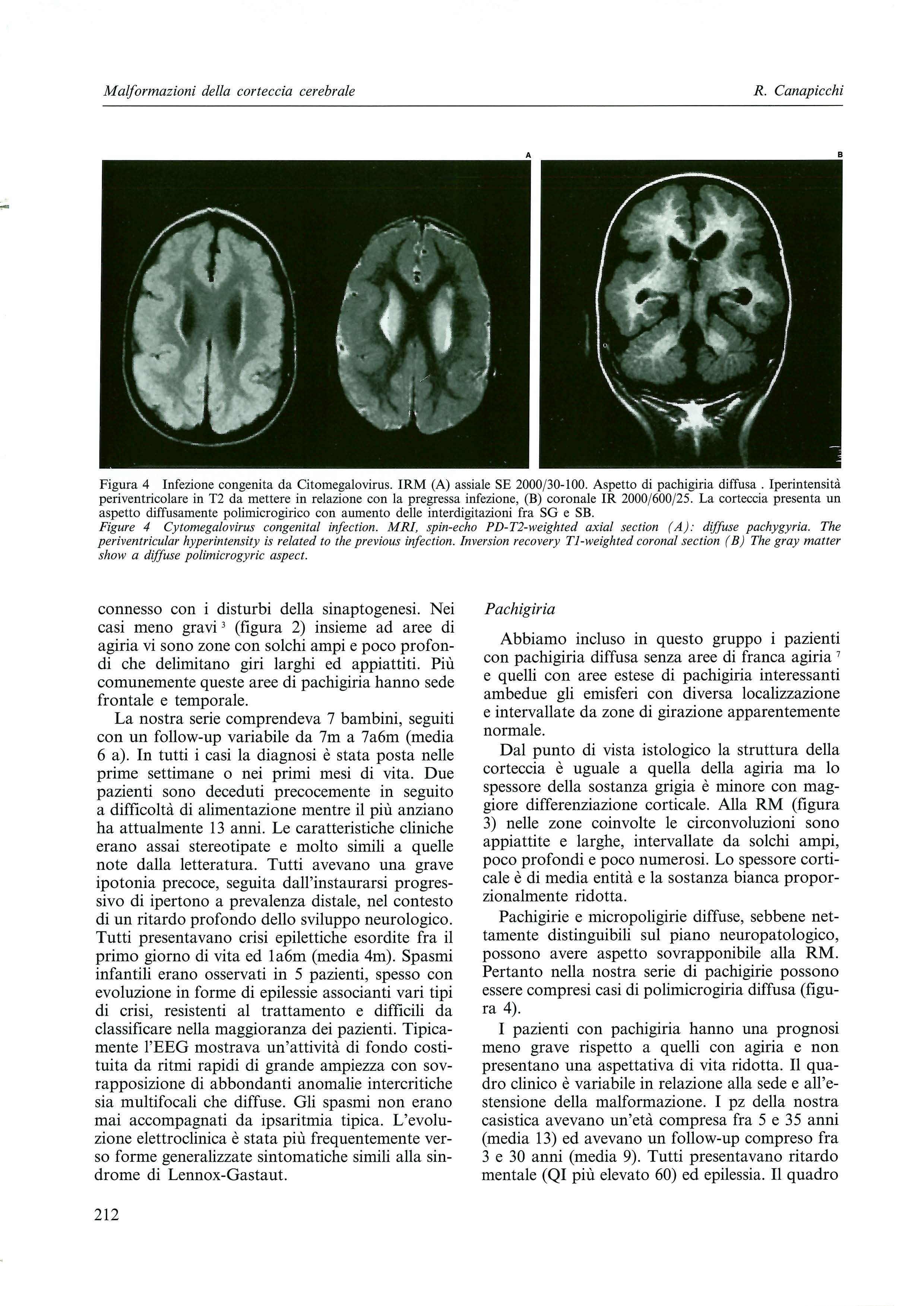 Malformazioni della corteccia cerebrate R. Canapicchi Figura 4 Infezione congenita da Citomegalovirus. IRM (A) assiale SE 2000/30-100. Aspetto di pachigiria diffusa.