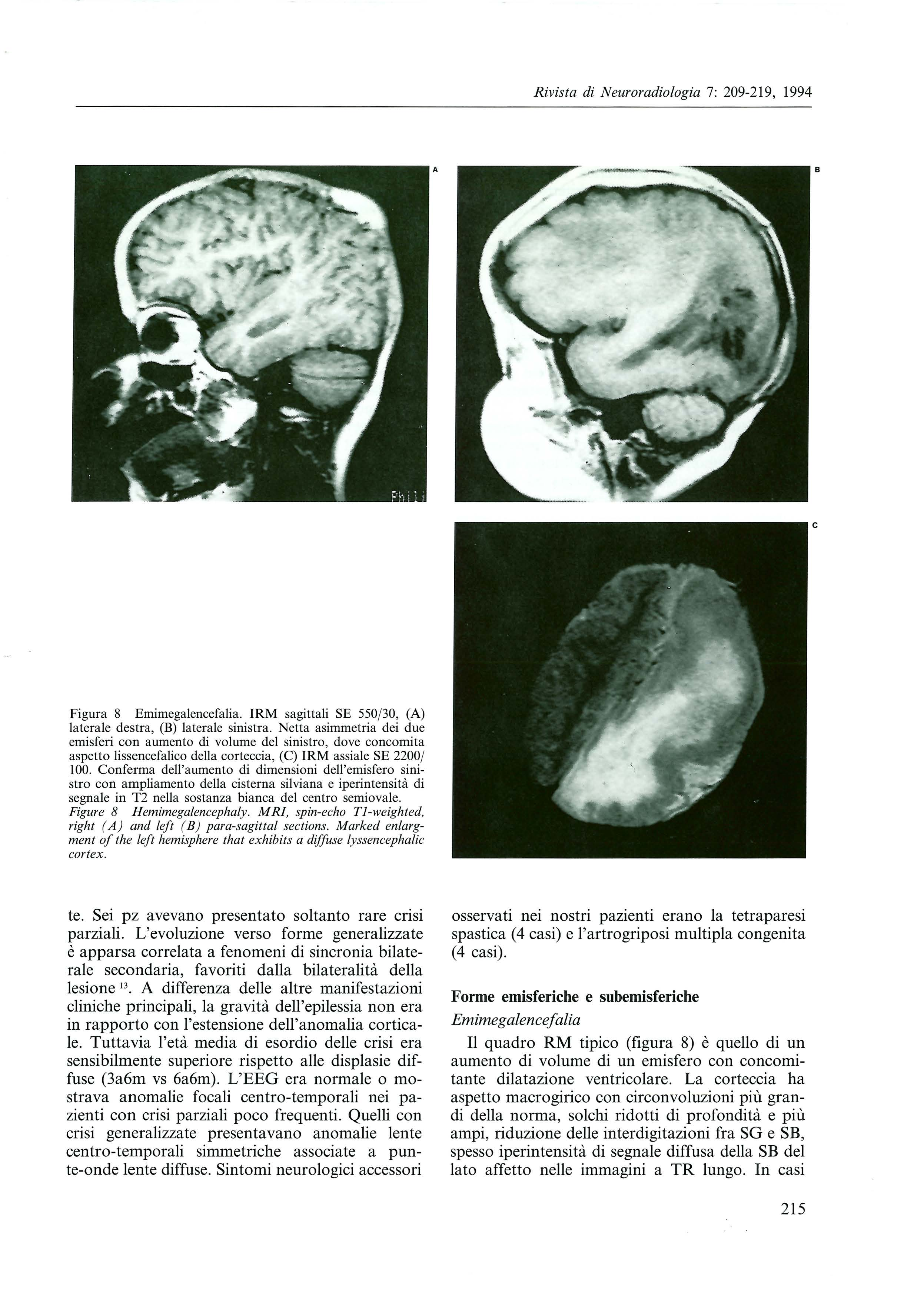 A B c Figura 8 Emimegalencefalia. IRM sagittali SE 550/30, (A) laterale destra, (B) laterale sinistra.
