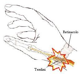 SINDROME DI DE QUERVAIN Segni Debolezza a livello del I comparto tendineo, lieve tumefazione della