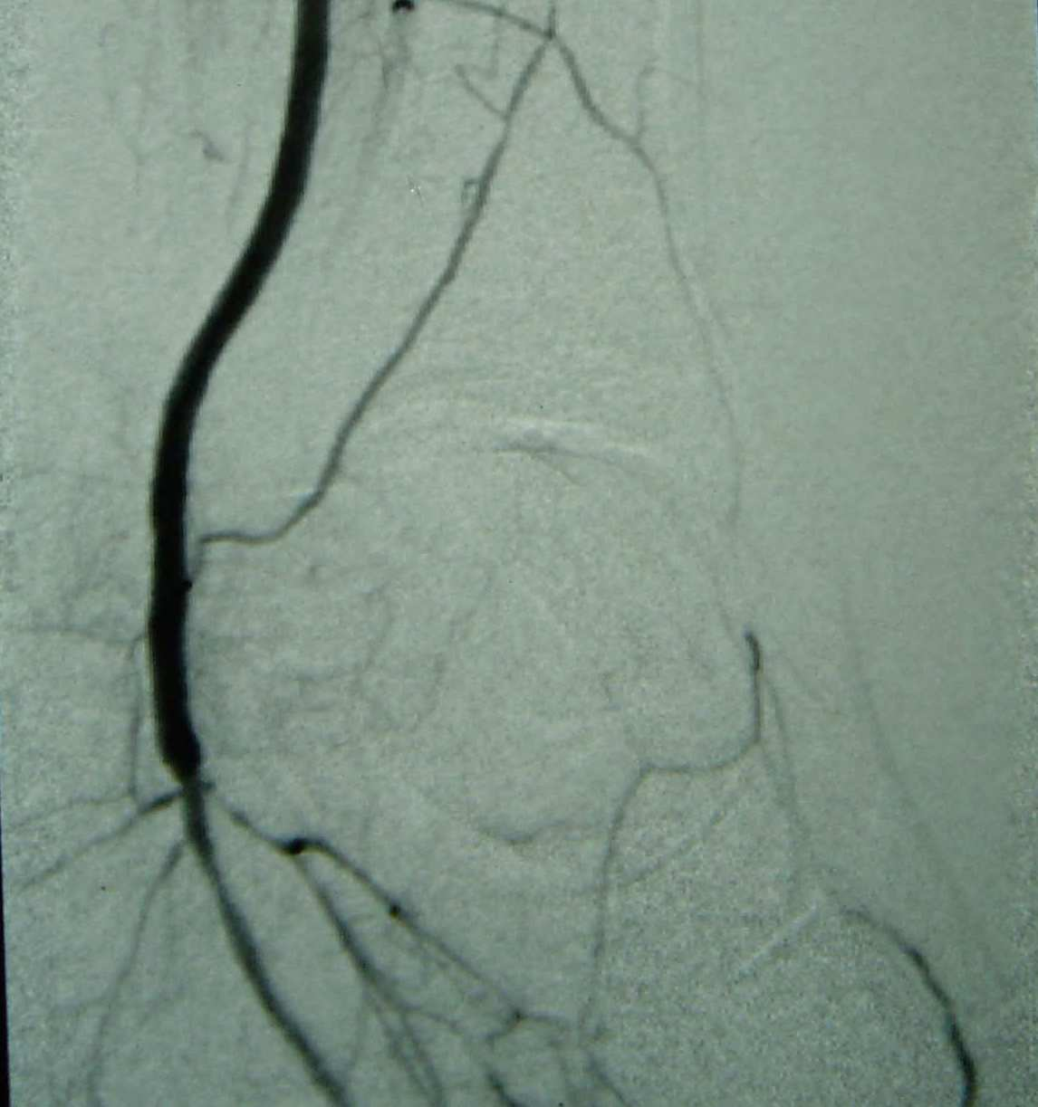 Saphenous vein conduit is the choice for FEMORO-DISTAL and INFRAPOPLITEAL by-pass as INITIAL option for CLI BASIL II - TASC - PREVENT III In patients with CLI, the absence of a good quality