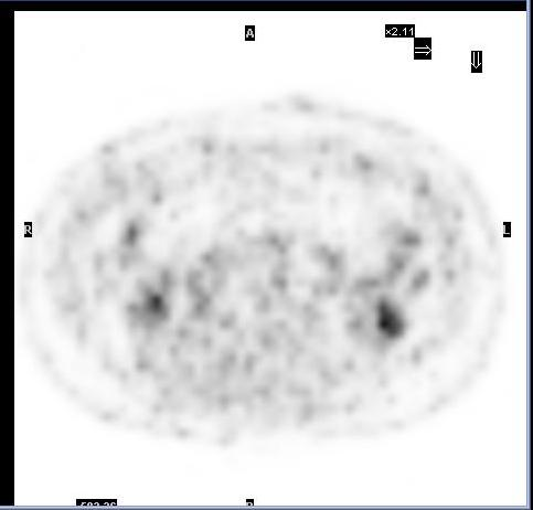 Risposta a fine trattamento chemioterapico: RISPOSTA COMPLETA Istologico: seminoma classico pt2, N2 (ln