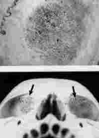 Iperostosi porotica Cribra orbitalia (sotto i gradi di gravità) Strie di Harris
