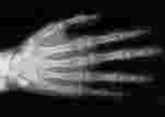 Terminologia radioscopica Ipertrasparenza: diminuzione della densità di immagine del tessuto osseo. Lacuna: ipertrasparenza circoscritta dell immagine del tessuto osseo.