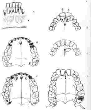 7. I caratteri non metrici Anomalie di forma e dimensione dei denti. 1. Incisivo di dimensioni notevolmente inferiori alla media, 2. Incisivo con radice curvata 3. Incisivo con corona malformata, 4.