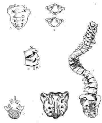 Anomalie della colonna vertebrale. A. Sacralizzazione parziale della quinta vertebra lombare. B. Atlante normale (sopra) e anomalo (sotto). C.