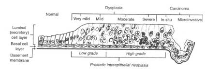 Fig. 1 Bostwick, 1999 Continuum morfologico da un normale epitelio prostatico al PIN di grado crescente fino al carcinoma in situ. Il PIN di basso grado (Low grade) corrisponde ad una lieve displasia.