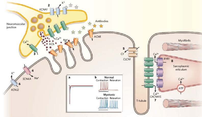 Canalopatie Muscolari Ipertermia maligna miastenia miotonia Paralisi periodica Il difetto genetico