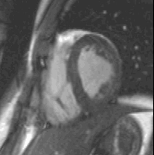 FIGURA 2 Sequenza cine SSFP (steady state free precession) in asse corto del ventricolo sinistro per visualizzazione della cinesi segmentaria (in alto a destra).
