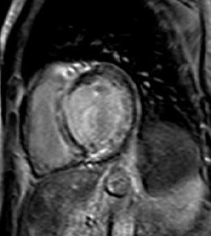 FIGURA 4 Schematizzazione dei potenziali meccanismi di iperhenancement dopo gadolinio in infarto acuto e cronico (5) (in alto).