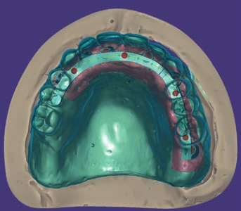 Fig. 6 Fig. 7 Fig. 8 Fig. 9 Fig. 6_Duplicazione montaggio denti con resina trasparente. Fig. 7_Placca in resina trasparente posizionata nel cavo orale dopo averla forata in corrispondenza dei transfert per la presa d impronta.