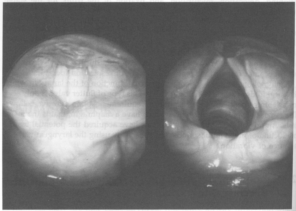 Quando la pressione sottoglottica vince le resistenze della glottide, il ciclo vibratorio inizia e con aggiustamenti continui si mantiene fino alla fine della corrente d aria.