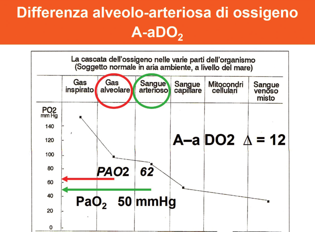 Fig. 9 Differenza Alveolo-arteriosa di 45 mmhg. Fig. 10 Differenza Alveolo-arteriosa di 12 mmhg.