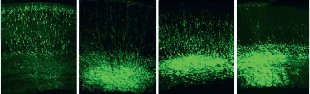 Alterata migrazione neuronale in sistemi neurali