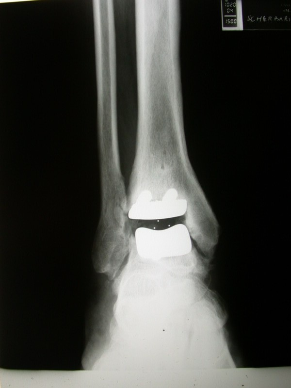 Fig7: Radiografie in proiezione laterale sotto carico in massima plantarflessione e dorsiflessione
