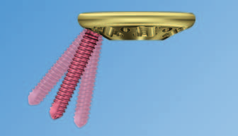 Sistema VA-Locking di fusione intercarpale. Tecnica ad angolo variabile per artrodesi mediocarpica parziale.