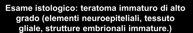 Laparotomia: escissione di neoformazione di 7x4 cm, contenente 30 cc di liquido siero-ematico e formazione solida aggettante nel lume Esame istologico: teratoma immaturo di alto