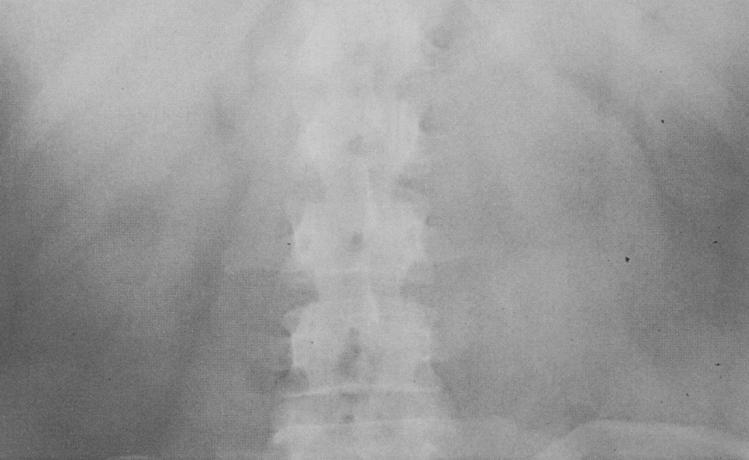 Urografia: esame diretto Tomografia delle logge renali