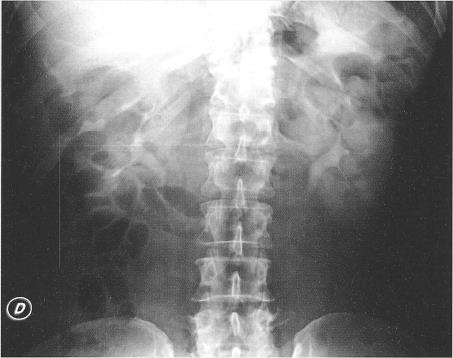 Urografia: fase contrastografica 1^ radiogramma: fase nefrografica 2^