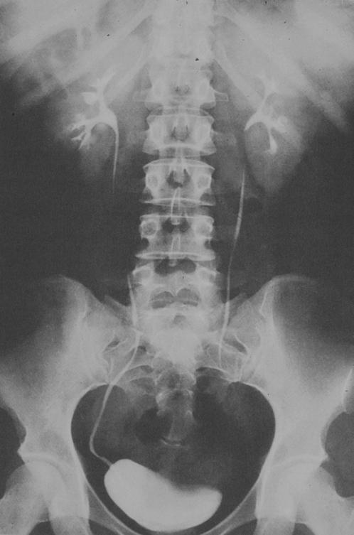 Urografia: fase contrastografica 3^ radiogramma: fase